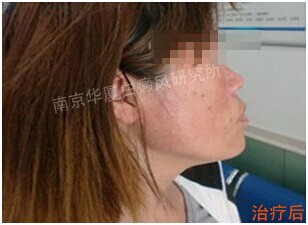 南京华厦白癜风研究所