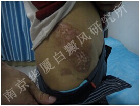 南京华厦白癜风研究所