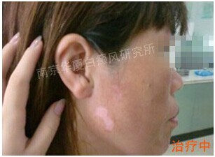 南京华厦白癜风研究所