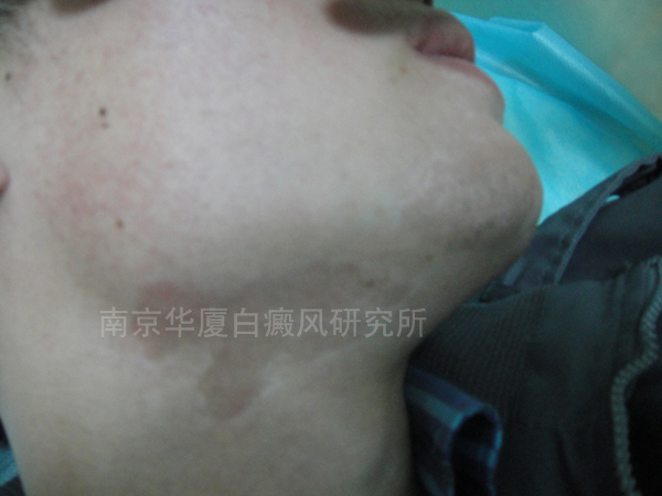 脸部白癜风治疗症状减轻