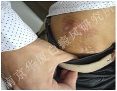 南京华厦白癜风研究所