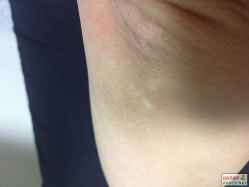 女性脸上长白斑是怎么回事