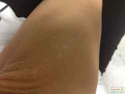 【白癜风常识】