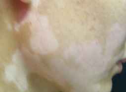 白癜风治疗